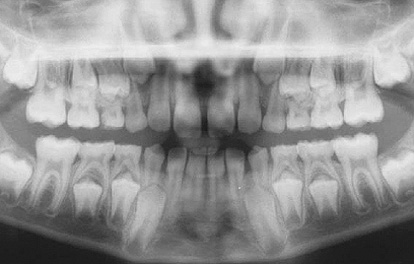 Radiographie panoramique montrant un patron d'éruption normal pour un jeune de 9 ans. Un suivi adéquat assurera l'éruption optimale des dents au cours des années subséquentes.