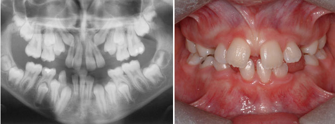 A panoramic X-ray allows the evaluation in more depth what is not always visible in the mouth