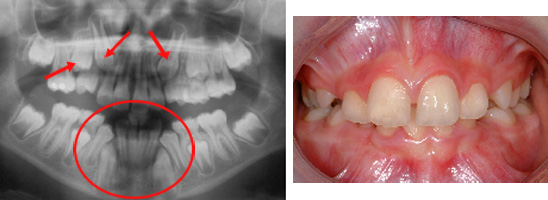 Loss of space and eruption problems visible on a X-ray of an 11-year-old young boy