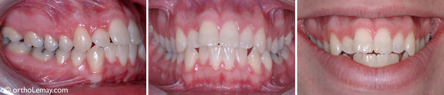 22-year-old patient complaining about his showing too much gum when smiling
