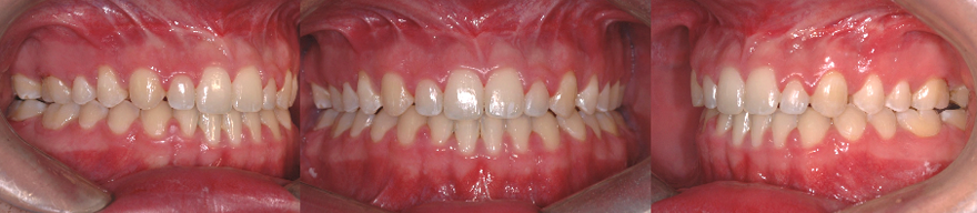 Closing of the anterior open bite following the orthodontic treatment and a jaw surgery. This results in a better function (mastication and phonetics).