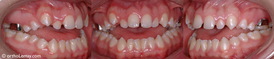 Severe anterior open bite necessitating an orthodontic treatment and a surgery to correct the bad relationship between the jaws in a 17-year-old boy.
